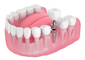 Illustration of a single dental implant
