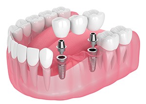 Illustration of an implant bridge