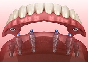 Illustration of a full denture being secured onto six dental implants