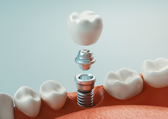 Illustration of a dental implant being placed in the lower jawbone