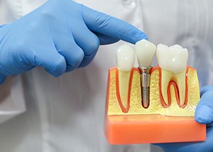 Gloved hands holding dental implant model