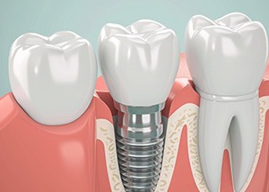 Illustration of dental implant next to natural tooth