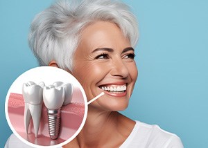 Smiling senior woman with a dental implant in her mouth