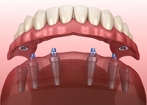 Illustration of a full denture being secured onto six dental implants