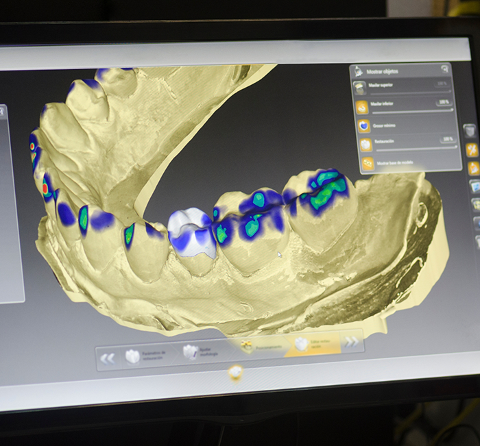 Digital impression of a row of teeth on a computer screen