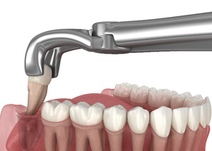 A CGI of a wisdom tooth being extracted