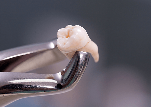 Dental clasp holding an extracted tooth