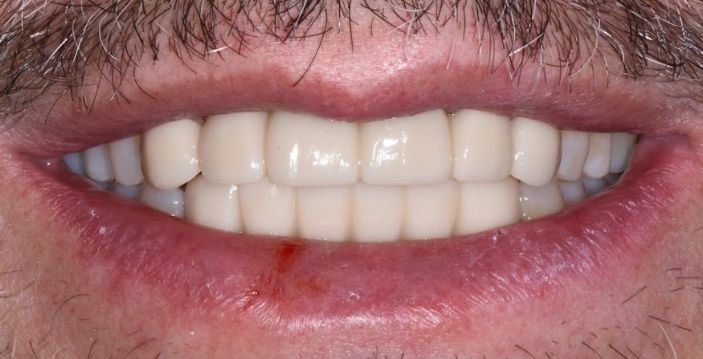Close up of a man smiling with a complete set of flawless teeth