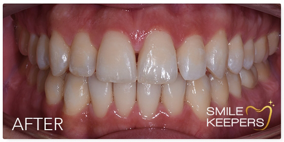Close up of a mouth with evenly aligned teeth