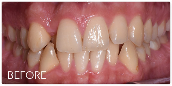 Close up of a mouth with crowded and overlapping teeth