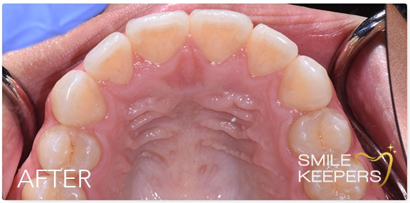 Close up of an upper row of straightened teeth