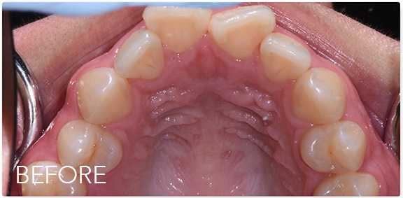Close up of an upper row of crooked teeth