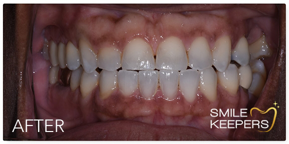 Mouth with evenly spaced teeth