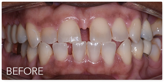 Mouth with gapped teeth