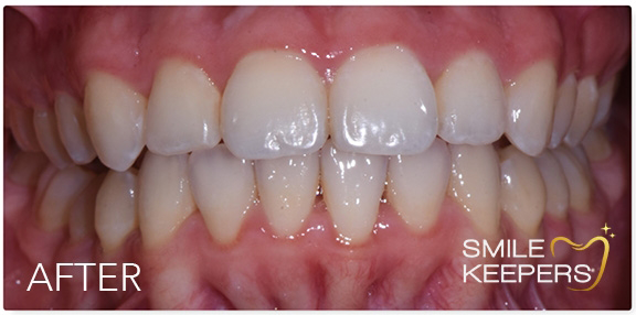 Mouth with whiter and more evenly aligned teeth