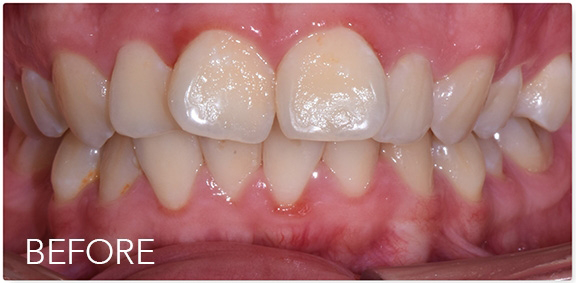 Mouth with slightly discolored and misaligned teeth
