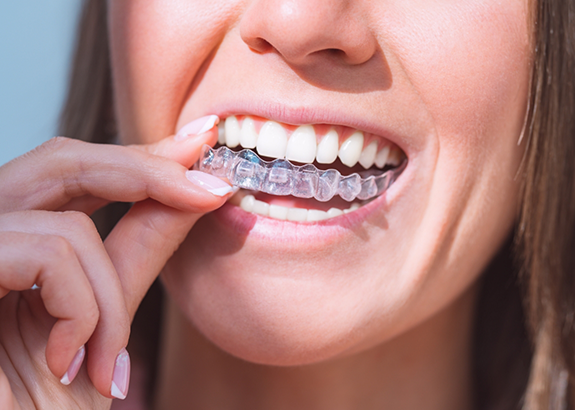 Close up of a woman placing an Invisalign clear aligner over her teeth