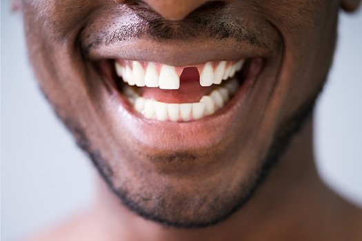 Patient in Bellville smiling with missing tooth