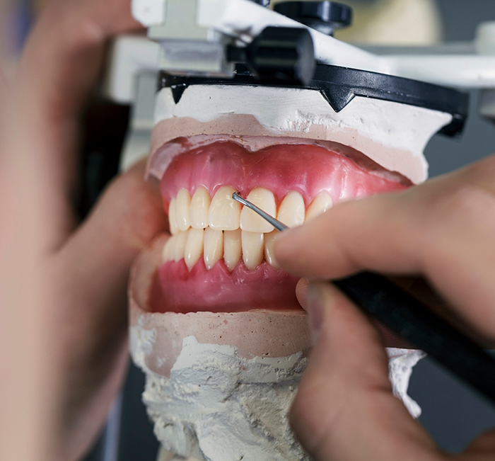 Dentist adjusting a model of a denture for replacing missing teeth