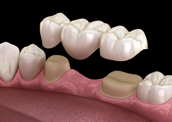 Illustration of a dental bridge filling the gap between two natural teeth