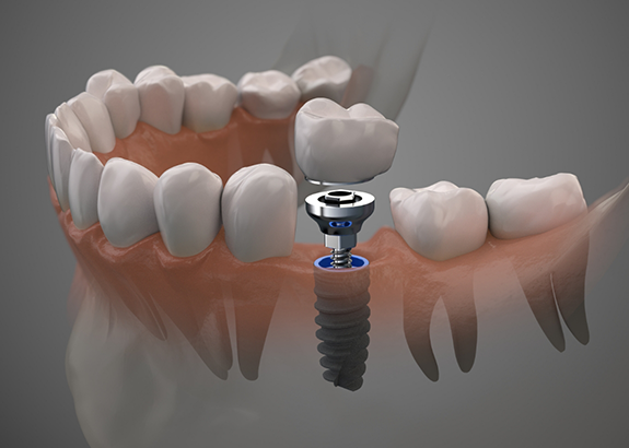 Illustration of a dental implant and crown replacing a missing lower tooth