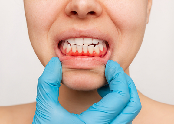 Close up of a person with red gums