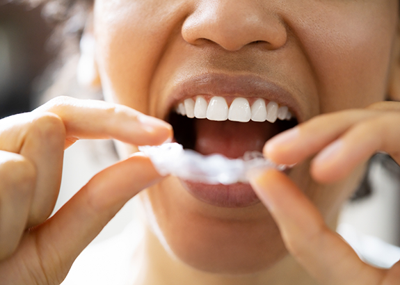 Person placing a white nightguard over their teeth