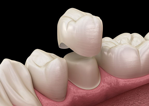 Illustration of a dental crown covering a tooth