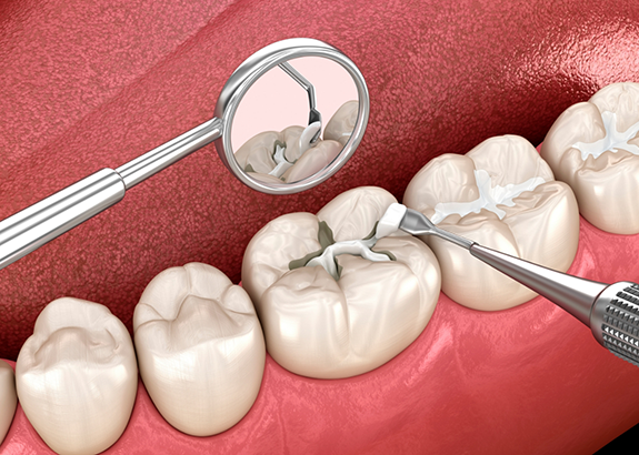 Illustration of a white filling being placed in a tooth