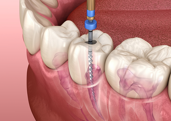 Illustration of a thin dental instrument treating the inside of a tooth