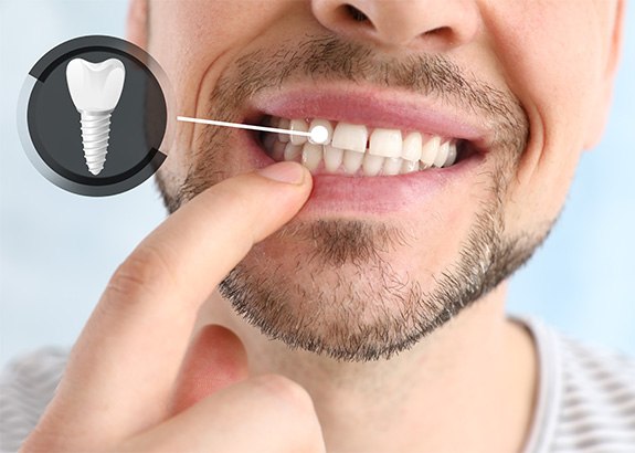 There are many factors that affect the cost of your dental implant treatment at Smile Keepers