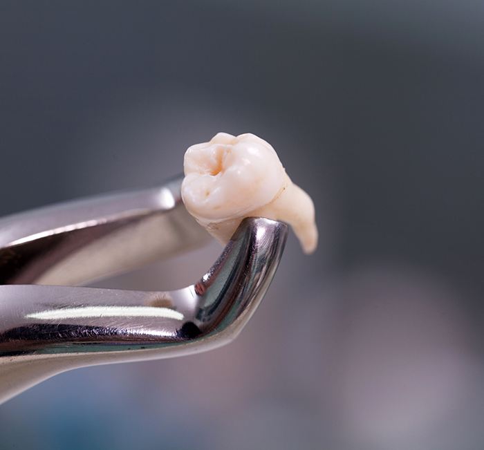 Dental clasp holding an extracted tooth