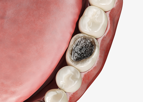 Close up of a mouth with a black tooth that needs to be extracted
