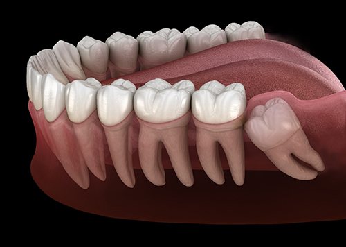Illustration of wisdom tooth growing in sideways
