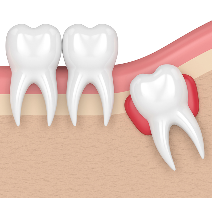 Illustration of an impacted wisdom tooth pressing against the adjacent tooth