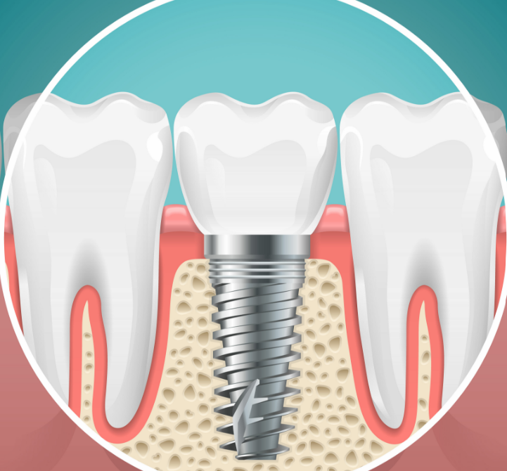 Illustration of a dental implant