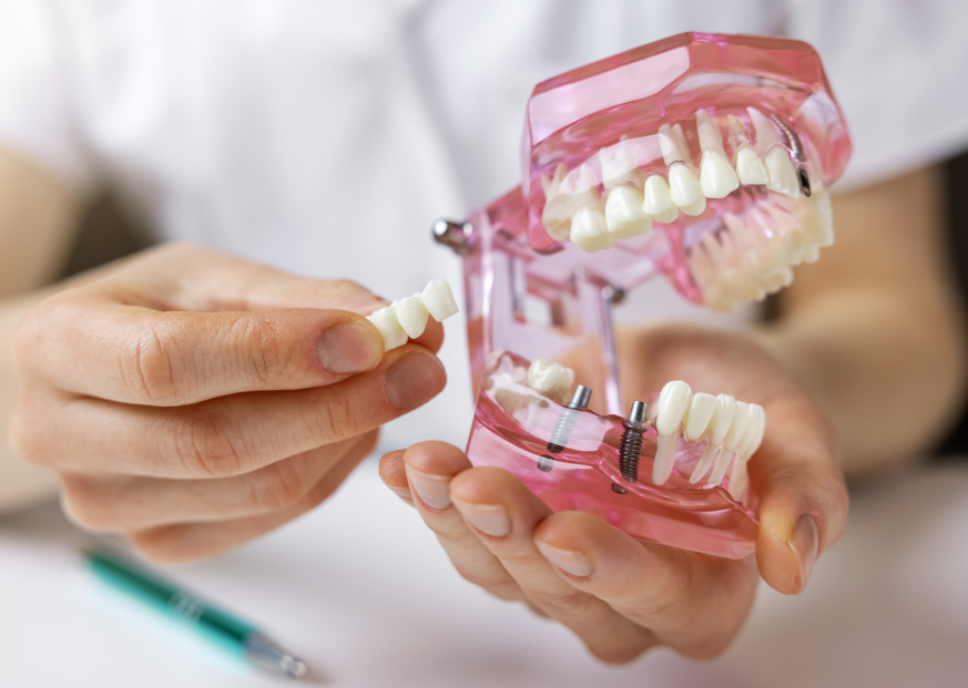 Dental implant model